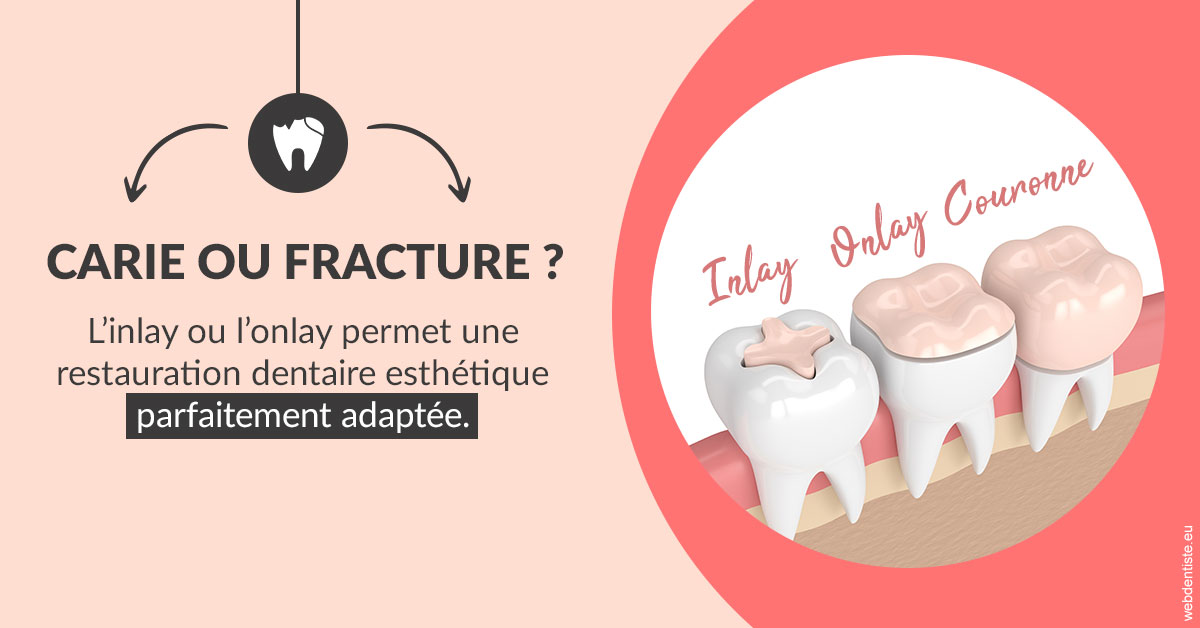 https://dr-grandemenge-agnes.chirurgiens-dentistes.fr/T2 2023 - Carie ou fracture 2
