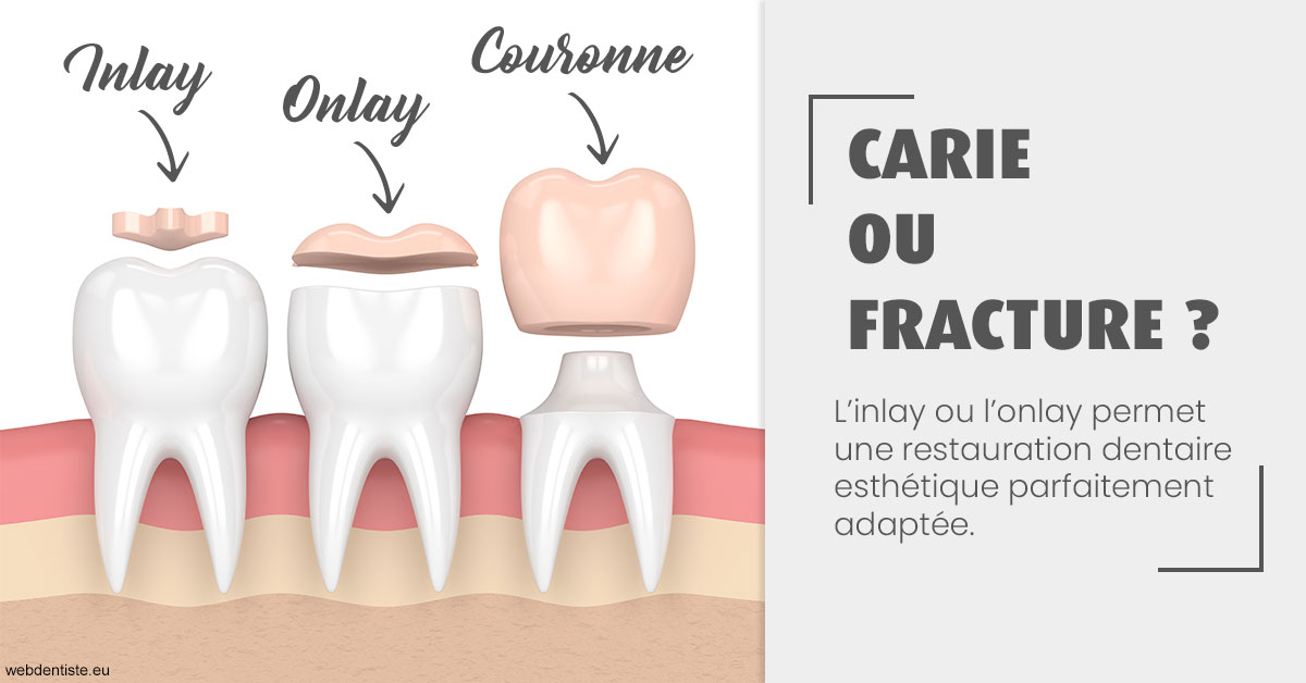 https://dr-grandemenge-agnes.chirurgiens-dentistes.fr/T2 2023 - Carie ou fracture 1