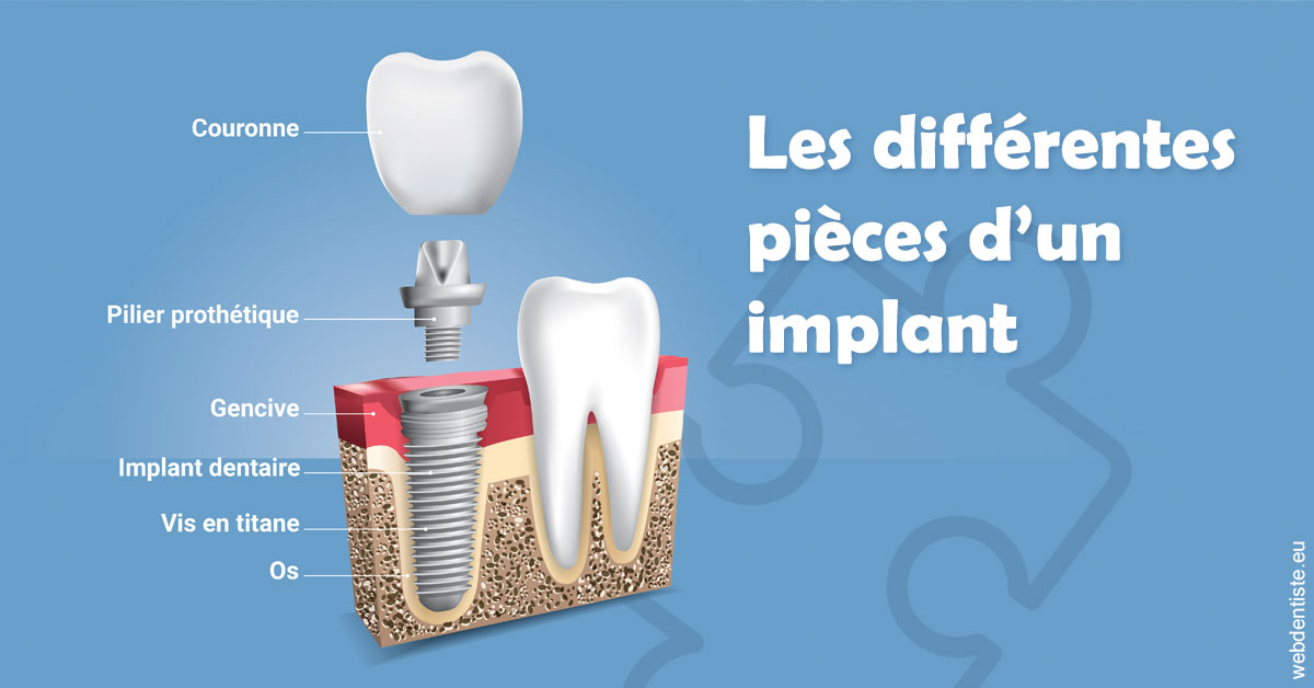 https://dr-grandemenge-agnes.chirurgiens-dentistes.fr/Les différentes pièces d’un implant 1